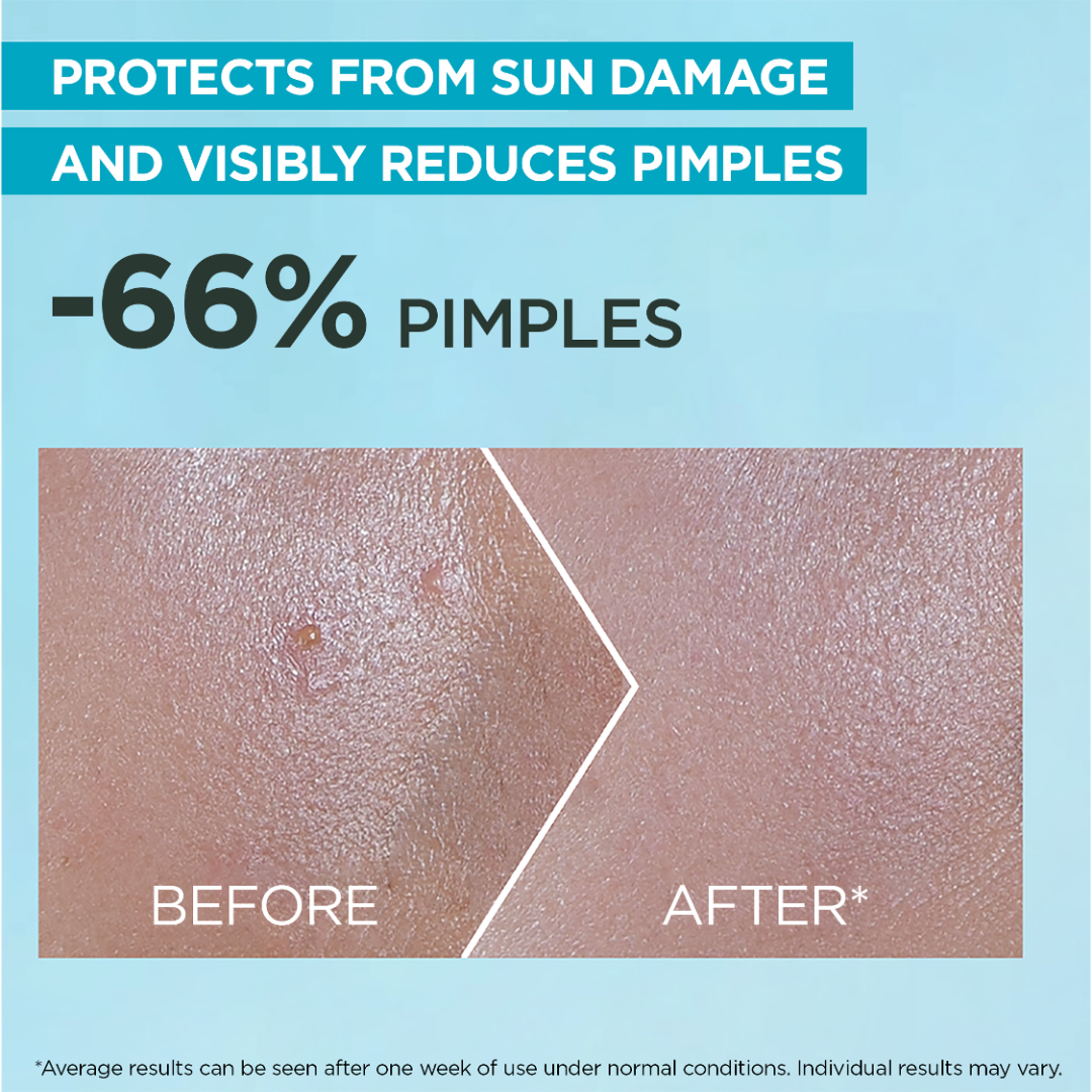 Super UV Anti-Acne SPF50+ Sunscreen – 12H Oil Control - Before & After